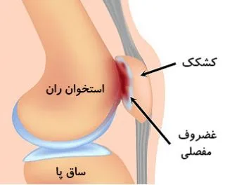 سندروم درد پاتلوفمورال باعث قرمزی عضله می شود. از شایع ترین علائم سندروم درد پاتلوفمورال، اختلال در حرکت مفصل زانو می باشد.