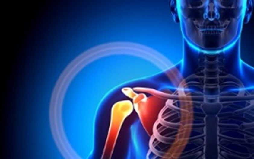 جدا شدن یا باریک شدن استخوان بازو سبب سندروم گیرافتادگی شانه می شود. ناهنجارهای ساختاری منجر به سندروم گیرافتادگی شانه می شوند.