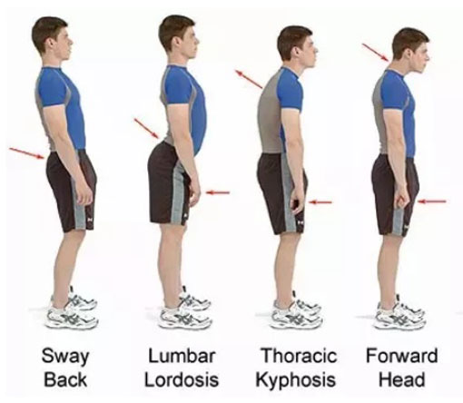 درجات کیفوز در افراد متفاوت است. کیفوز انواع مختلفی دارد.