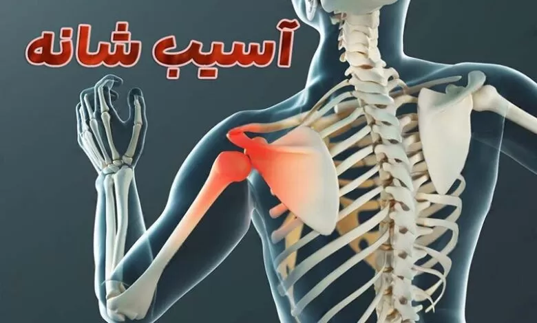 تورم و قرمزی یکی از علائم عدم ثبات مفصل شانه است. عدم ثبات مفصل شانه باعث سستی و لغزش در مفصل می شود.