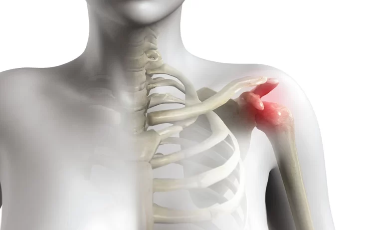 قرمزی و تورم در شانه از مهم ترین نشانه های سندروم گیرافتادگی شانه است. سندروم گیرافتادگی شانه زمانی رخ می دهد که بافت های نرم شانه توسط استخوان های اطراف فشرده شوند.