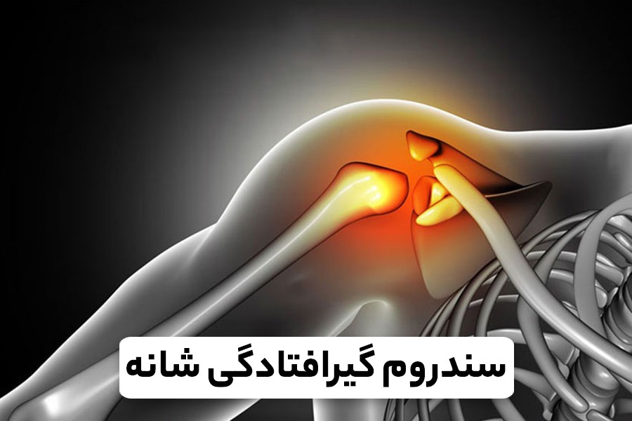 دررفتگی استخوان بازو منجر به سندروم گیرافتادگی شانه می شود. سندروم گیرافتادگی شانه یک حالت دردناک در شانه است.