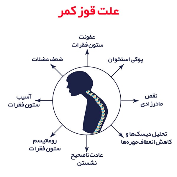 بیشتر علائم کیفوز مادرزادی است. کیفوز انحراف کمر به سمت جلو می باشد.