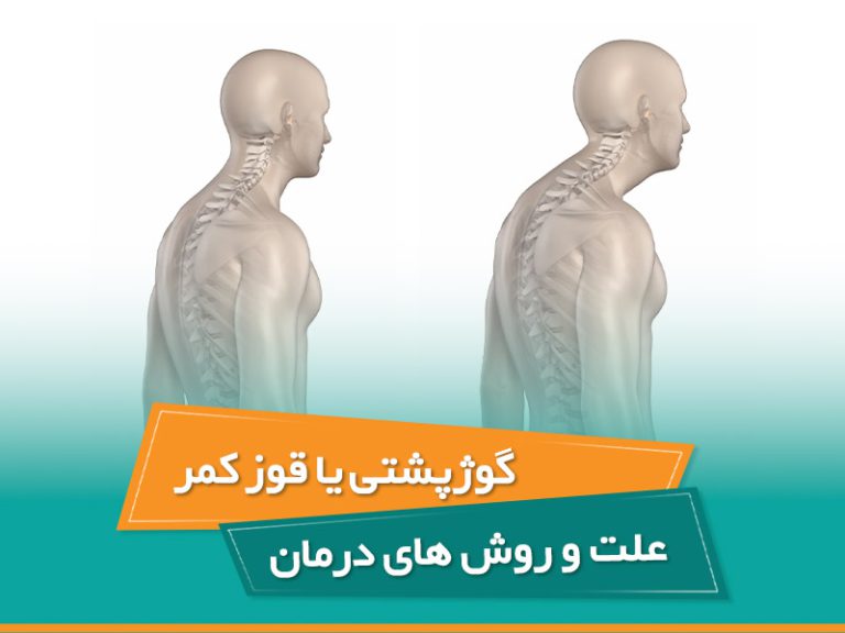گوژپشتی یا کیفوز یک انحنای ستون فقرات است. کیفوز یک اختلال ستون فقرات است.