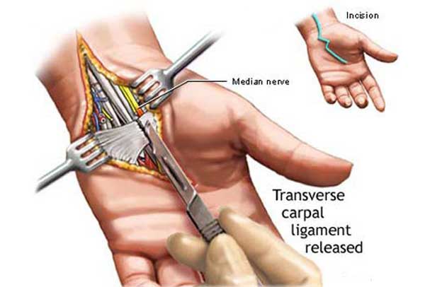 حرکات مکرر دست سبب سندروم تونل کارپال می شود.