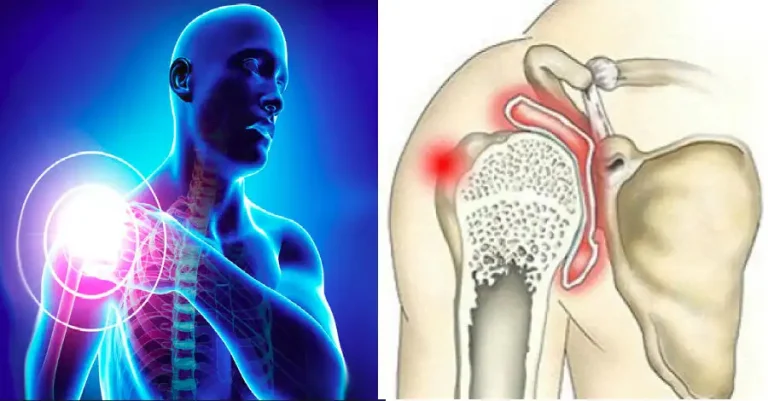 سستی مفصل کتف سبب عدم ثبات مفصل شانه می شود. هماهنگی دقیق بین ساختارهای روتاتور کاف سبب حفظ ثبات شانه می شوند.