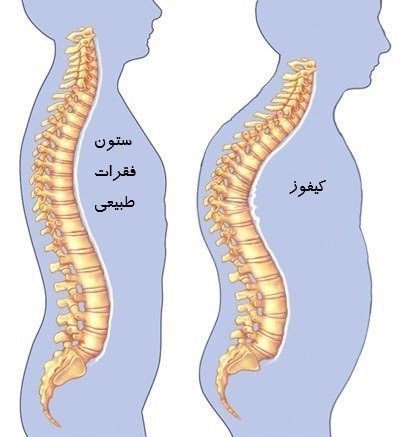 کیفوز سبب می شود که مهره ها به سمت جلو انحراف پیدا کند. برای بهبودی از کیفوز نیاز به پ وشیدن بریس کمر است.