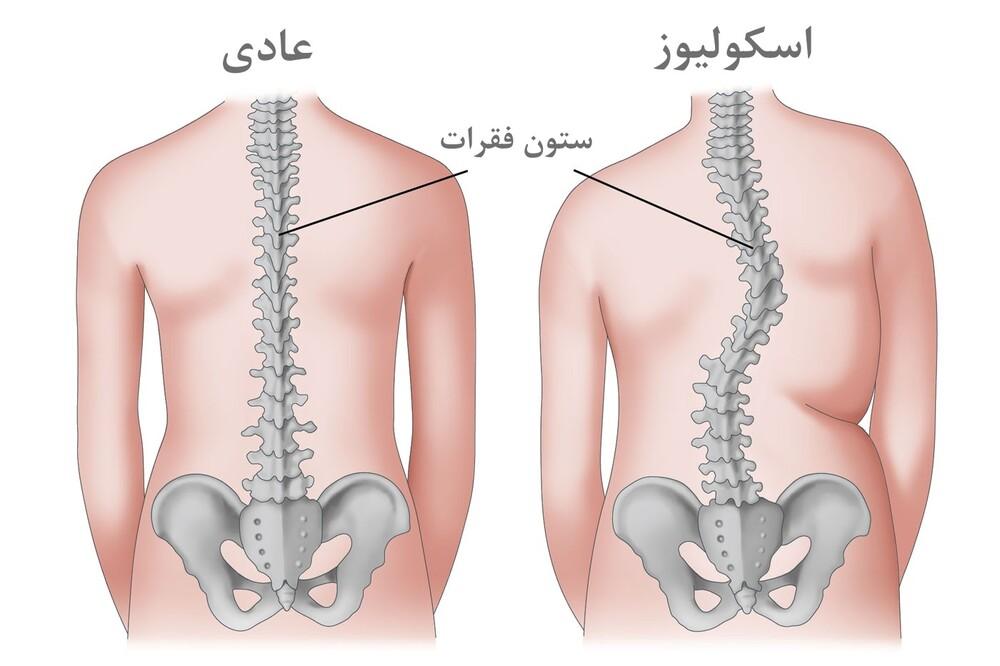 سندروم اسکولیوز یک اختلال در ساختار ستون فقرات است.
