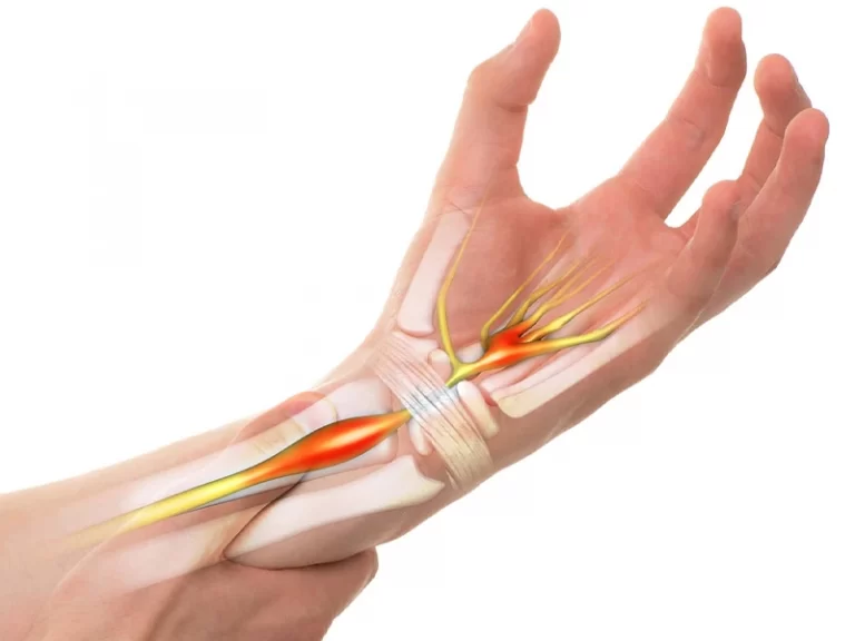 تورم عصب میانی دست به سبب فشردگی نوروپاتی است. یکی از علائم سندروم تونل کارپال بی حسی و گزگز است.