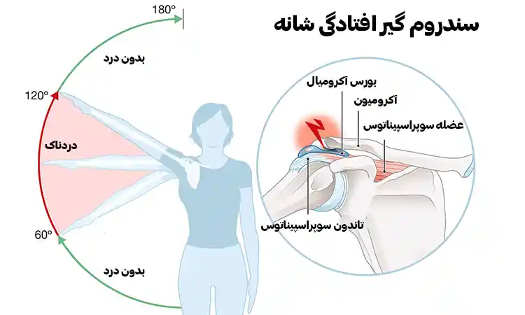 ضعف عضلانی در بازو، یکی از نشانه های مهم سندروم گیرافتادگی شانه است.