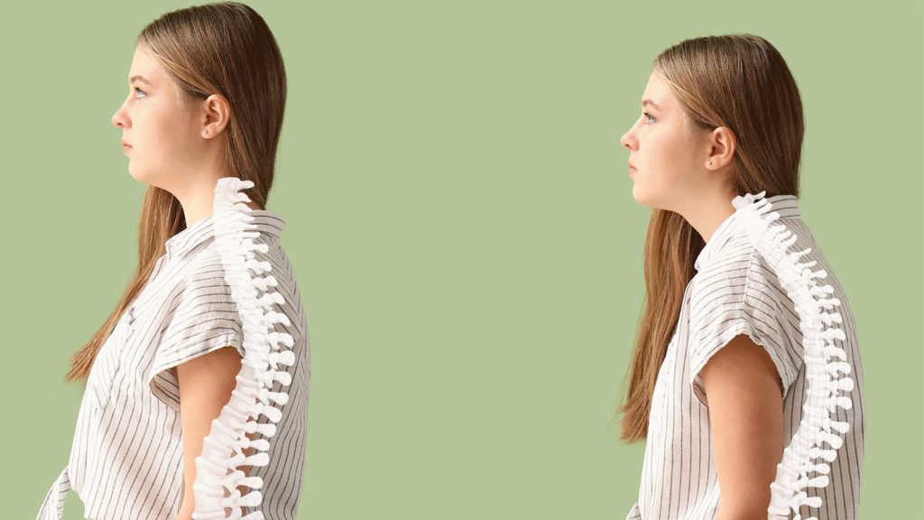 کیفوز باعث کوتاهی قد می شود. صاف کردن کمر برای بیماری که دارای کیفوز است، غیر ممکن می باشد.