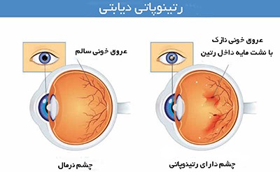 اگر نوروپاتی دیابتی دارید باید دیابت خود را مدیریت کنید. نوروپاتی دیابتی یکی از عوارض دیابت است که چشم ها را تحت تاثیر قرار می دهد.