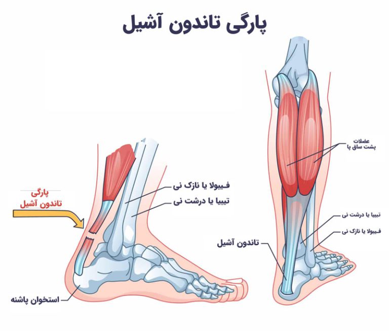 تاندون آشیل بزرگترین تاندون در بدن ماست که عضلات ساق پا را به استخوان پاشنه متصل می کند. پارگی تاندون آشیل آسیبی است که پشت ساق پا را تحت تاثیر قرار می دهد.