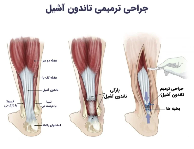 استفاده از آرتروسکوپی از طریق یک برش کوچک در پاشنه برای ترمیم پارگی یا جراحی باز در پاشنه. پارگی تاندون آشیل به دلیل ضربه مستقیم رخ می دهد.