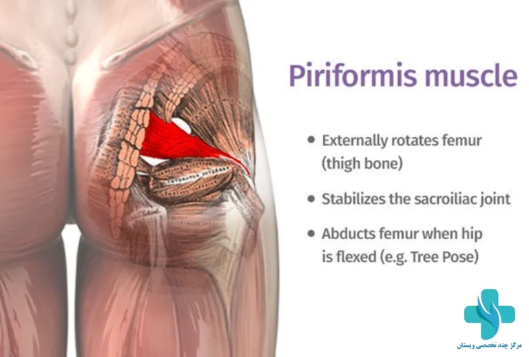 سندروم پیریفورمیس معمولا یک مفصل ران را تحت تاثیر قرار می دهد.