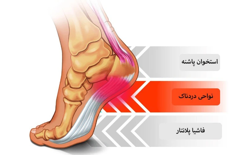 خار پاشنه از پایین پاشنه تا قوس پا امتداد دارد. علائم خار پاشنه چیست؟
شایع ترین علامت خار پاشنه درد، گزگز و سوزش هنگام تماس پا با زمین است.