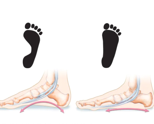 نداشتن قوس طبیعی در پا سبب ایجاد صافی کف پا می شود. صافی کف پا یک بیماری شایع است.