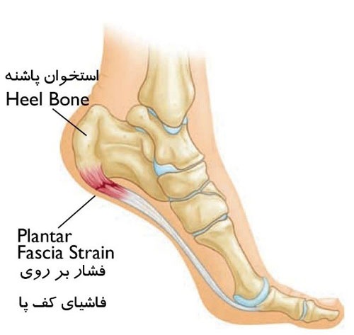 درد فاشئیت پلانتار با ورزش بهبود می یابد.
