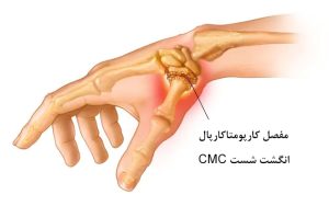 تورم و قرمزی در مفصل به سبب ساییده شدن استخوان انگشت شست است. آرتروز انگشت شست باعث سفتی دست می شود.