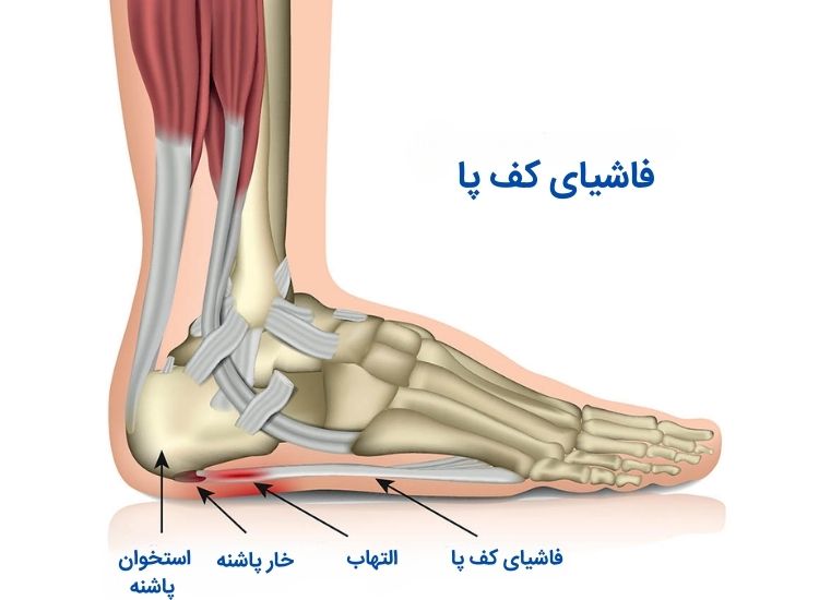 افرادی که دارای فاشئیت پلانتار هستند، احساس درد و سفتی در پاشنه می کنند. فاشئیت پلانتار یکی از شایع ترین علل درد پاشنه پا است.
