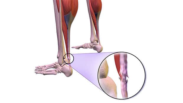 پارگی تاندون آشیل سبب مختل کردن حرکت طبیعی بیمار می شود.