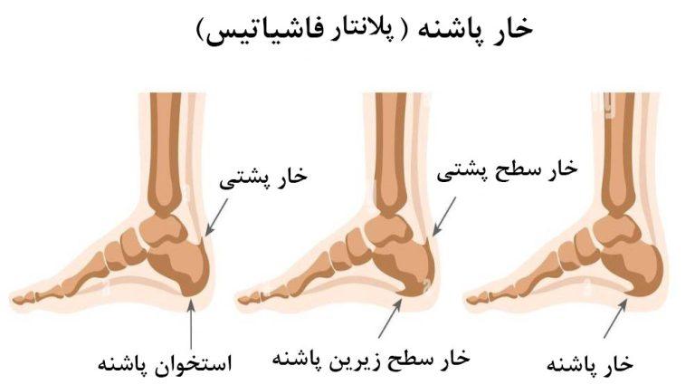 علائم خار پاشنه از فردی به فرد دیگر متفاوت است. خار پاشنه چیست؟ خار پاشنه در زنان شایع تر است.