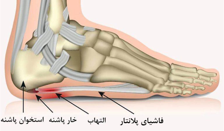 یک نقطه دردناک در زیر پاشنه که راه رفتن با پای برهنه را دشوار می کند. خار پاشنه چیست؟
خار پاشنه از جلوی پاشنه شروع می شود و به تدریج به سایر قسمت های پا گسترش می یابد.