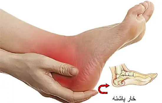 تشخیص خار پاشنه چیست؟ تشخیص خار پاشنه که به آرامی ایجاد می شود، بسیار دشوار است.