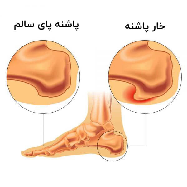 مهمترین عارضه خار پاشنه این است که می تواند باعث تورم استخوان پاشنه شود. خار پاشنه چیست؟
خار پاشنه یک زائده استخوانی روی پاشنه پا است.