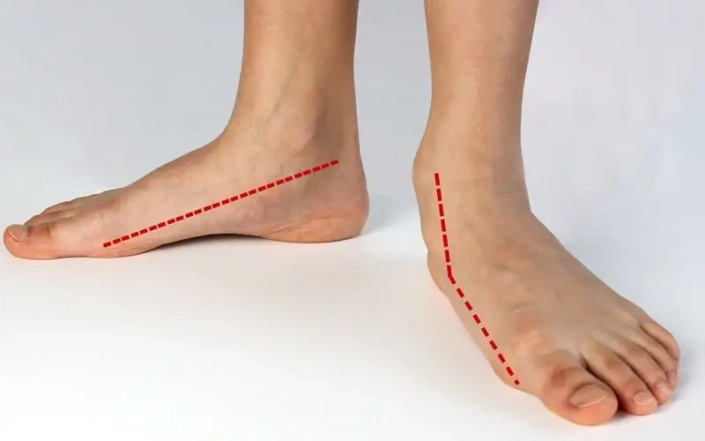 بیماری که دارای صافی کف پا است، فاقد انحنای طبیعی پا می باشد. صافی کف پا منچر به خستگی پاها می شود.