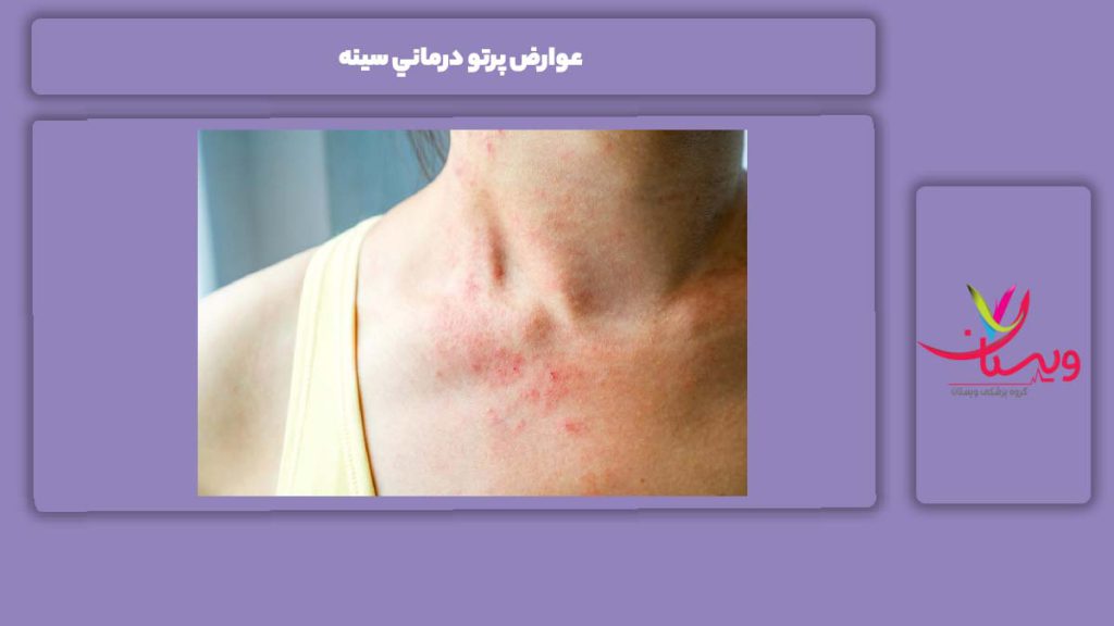عوارض عمومی عوارض پرتو درماني سينه