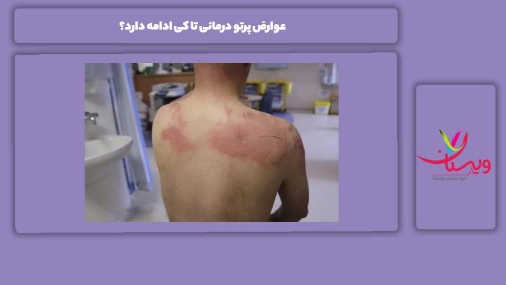 عوارض میانمدت عوارض پرتو درمانی تا کی ادامه دارد؟