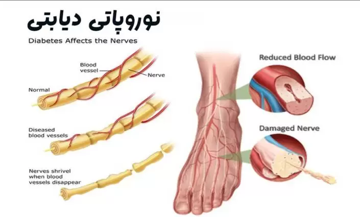 برای کاهش علائم نوروپاتی دیابتی، درمان های متعددی در دسترس است. نوروپاتی دیابتی یک عارضه طولانی مدت دیابت است.