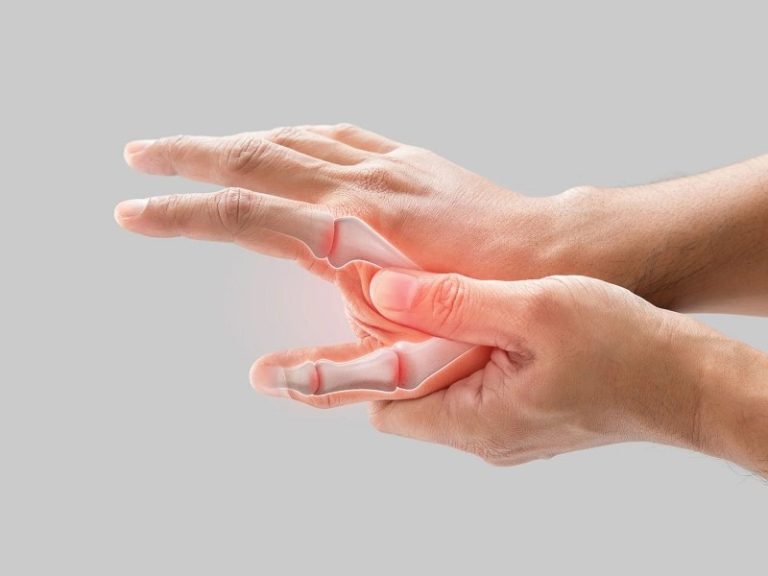 آرتروز انگشت شست به سبب ساییده شدن مفصل اتفاق می افتد. آرتروز انگشت شست یک بیماری شایع است.