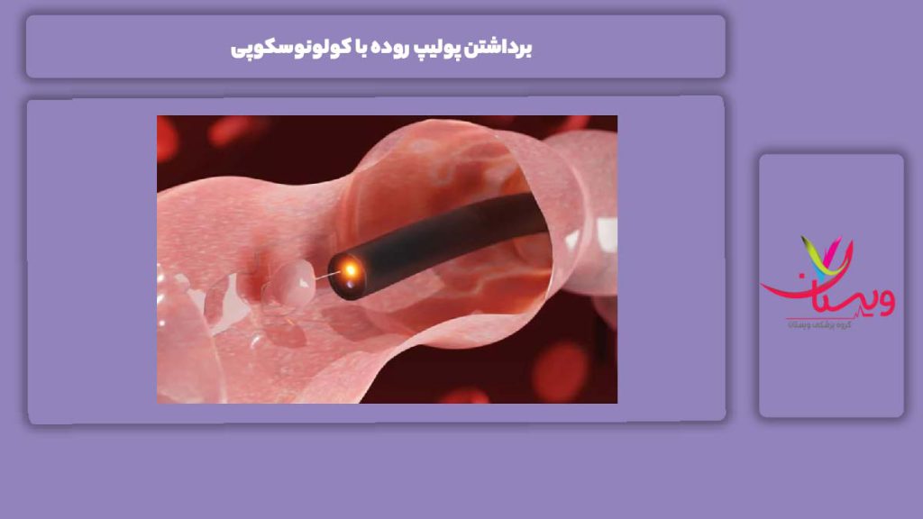 مراحل کولونوسکوپی برداشتن پولیپ روده با کولونوسکوپی