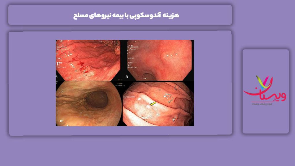 راهنمای استعلام و استفاده از این بیمه هزینه آندوسکوپی با بیمه نیروهای مسلح