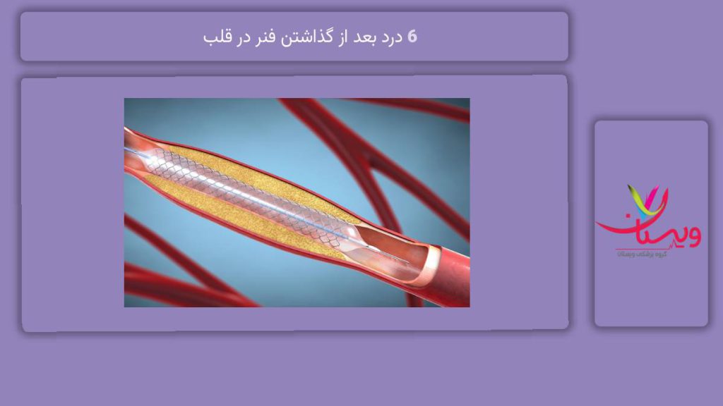 راهکار کاهش درد 6 درد بعد از گذاشتن فنر در قلب