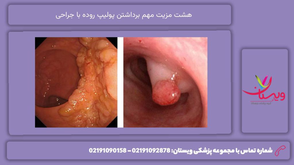 مهمترین مزایا هزینه عمل پولیپ روده