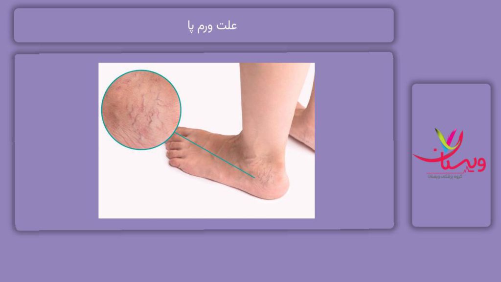 علتهای ورم در پا علت ورم پا