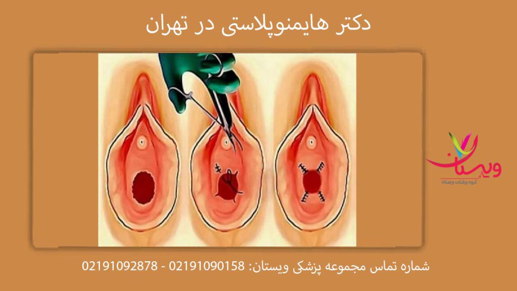 دکتر هایمنوپلاستی در تهران معرفی دكتر خوب برای ترميم بكارت در تهران