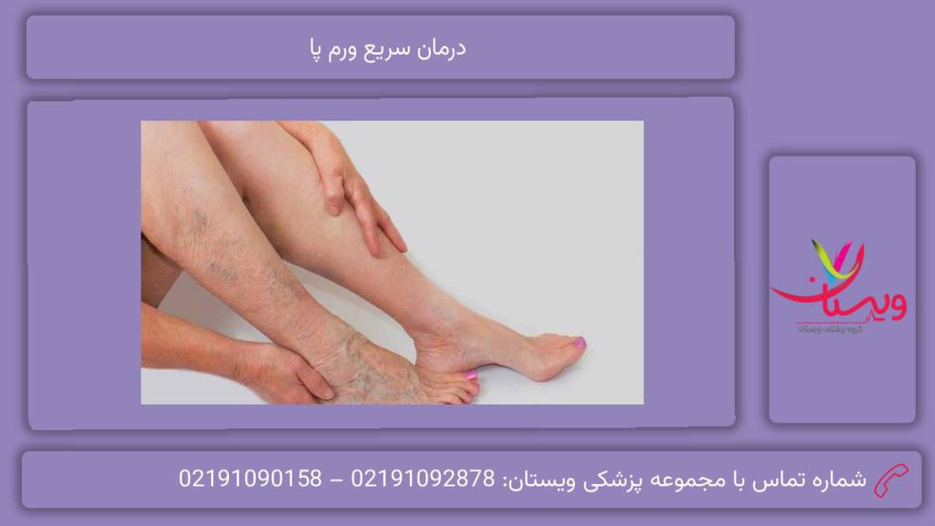 درمان سریع ورم پا علت ورم پا