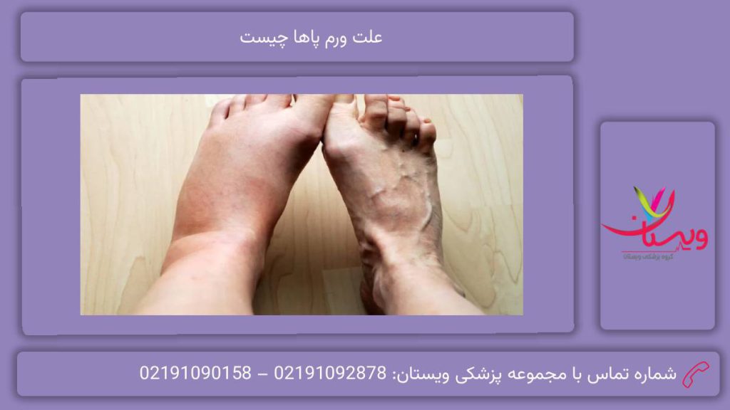 علائم ورمهای پا علت ورم پاها چیست