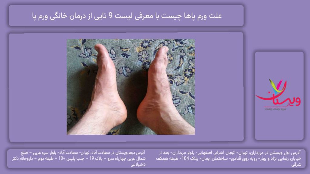 علت ورم پاها چیست
