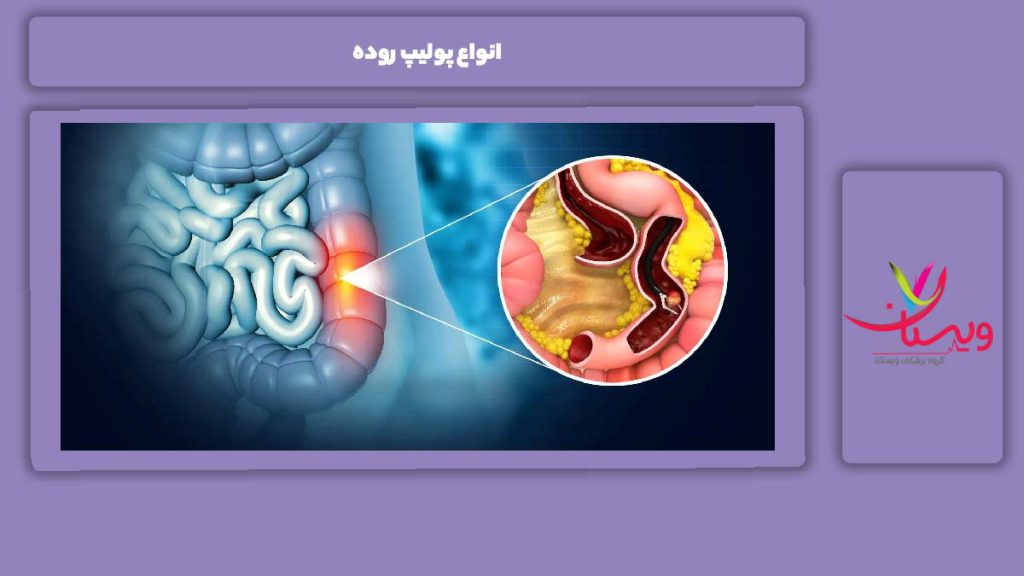 اقسام مختلف پولیپ روده انواع پولیپ روده
