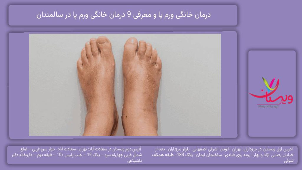 درمان خانگی ورم پا