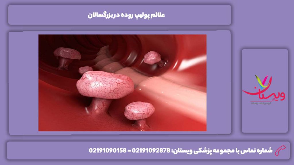 تشخیص علائم پولیپ روده علائم پولیپ روده در بزرگسالان