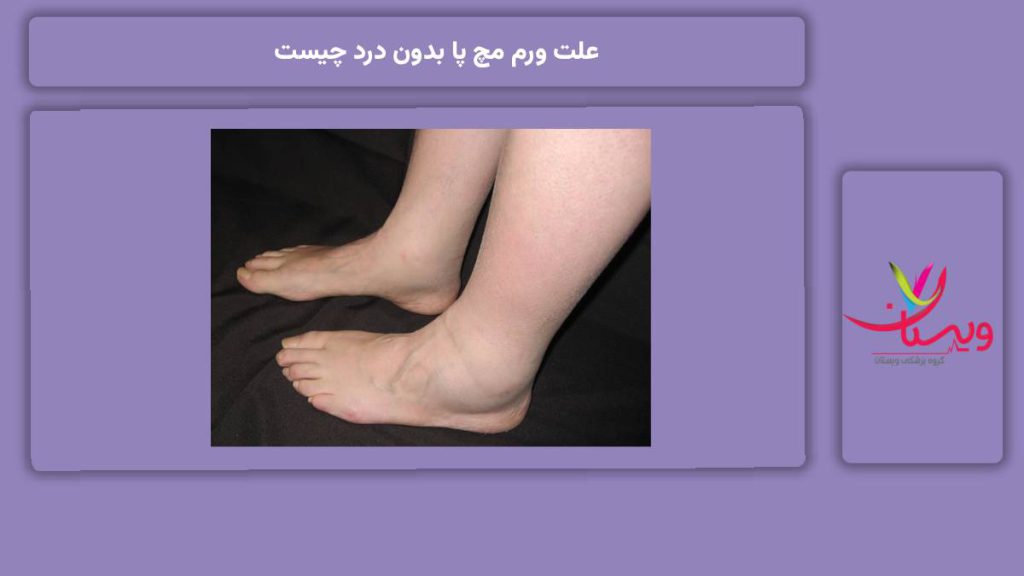 مریضیهایی که موجب ورم مچ پا بدون درد میشود. علت ورم مچ پا بدون درد چیست