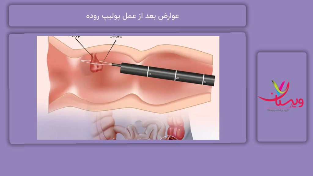عوارض شایع و خفیف عوارض بعد از عمل پولیپ روده