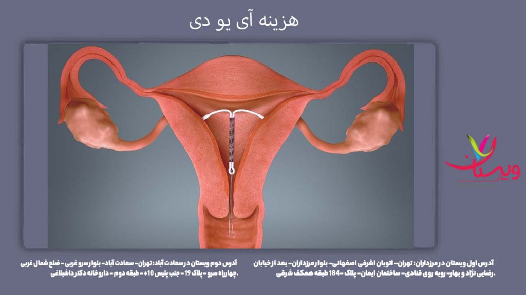 هزینه آی یو دی در سال ۱۴۰۴ هزینه گذاشتن iud سال 1404
