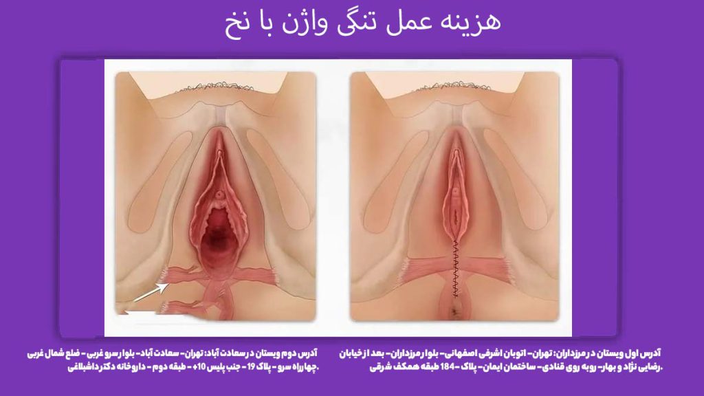 تعرفه واژینوپلاستی با نخ هزینه عمل تنگی واژن با نخ
